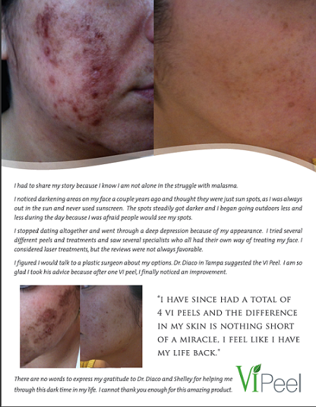 Now offering the VI Peel Now offering the VI Peel