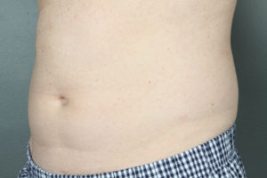 Oblique View Pre Velashape