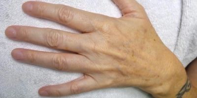 after bbl photofacial on hands case 6412