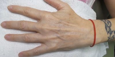 after bbl photofacial on hands case 6412