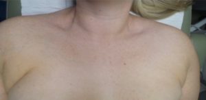 after BBL photofacial female patient chest case 6482