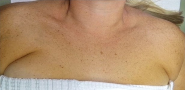 before BBL photofacial female patient chest case 6482