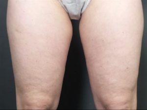 before coolsculpting legs front view female patient case 6479