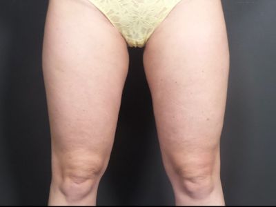 after coolsculpting legs front view female patient case 6479