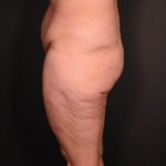 before body lift female patient side view case 6604