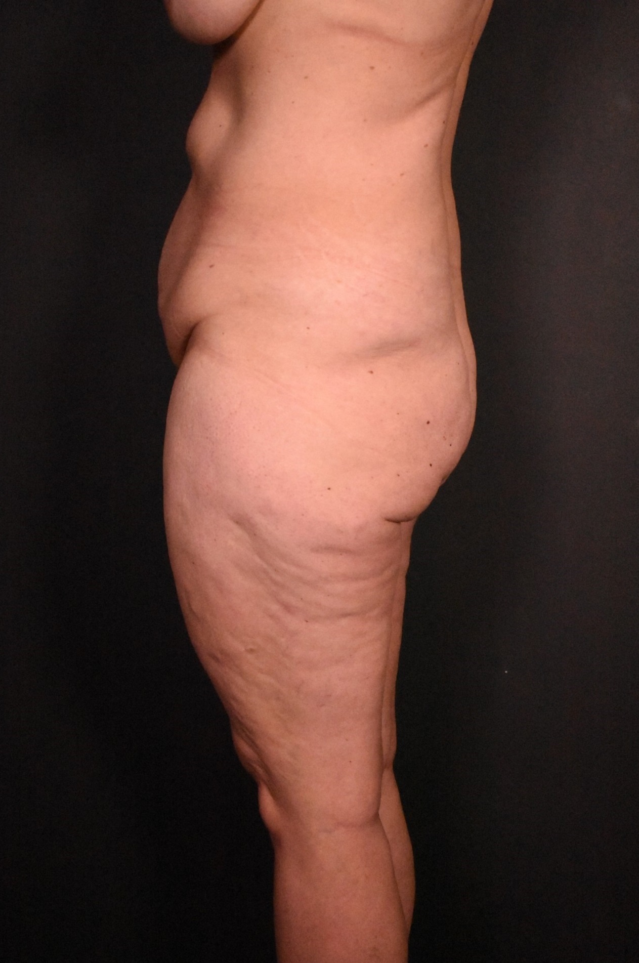 before body lift female patient side view case 6604