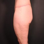 after body lift female patient side view case 6604