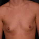 before breast augmentation front view case 6636