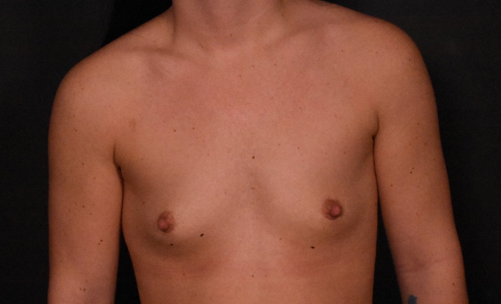 before breast augmentation front view case 6636