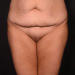 before tummy tuck front view female patient case 6727