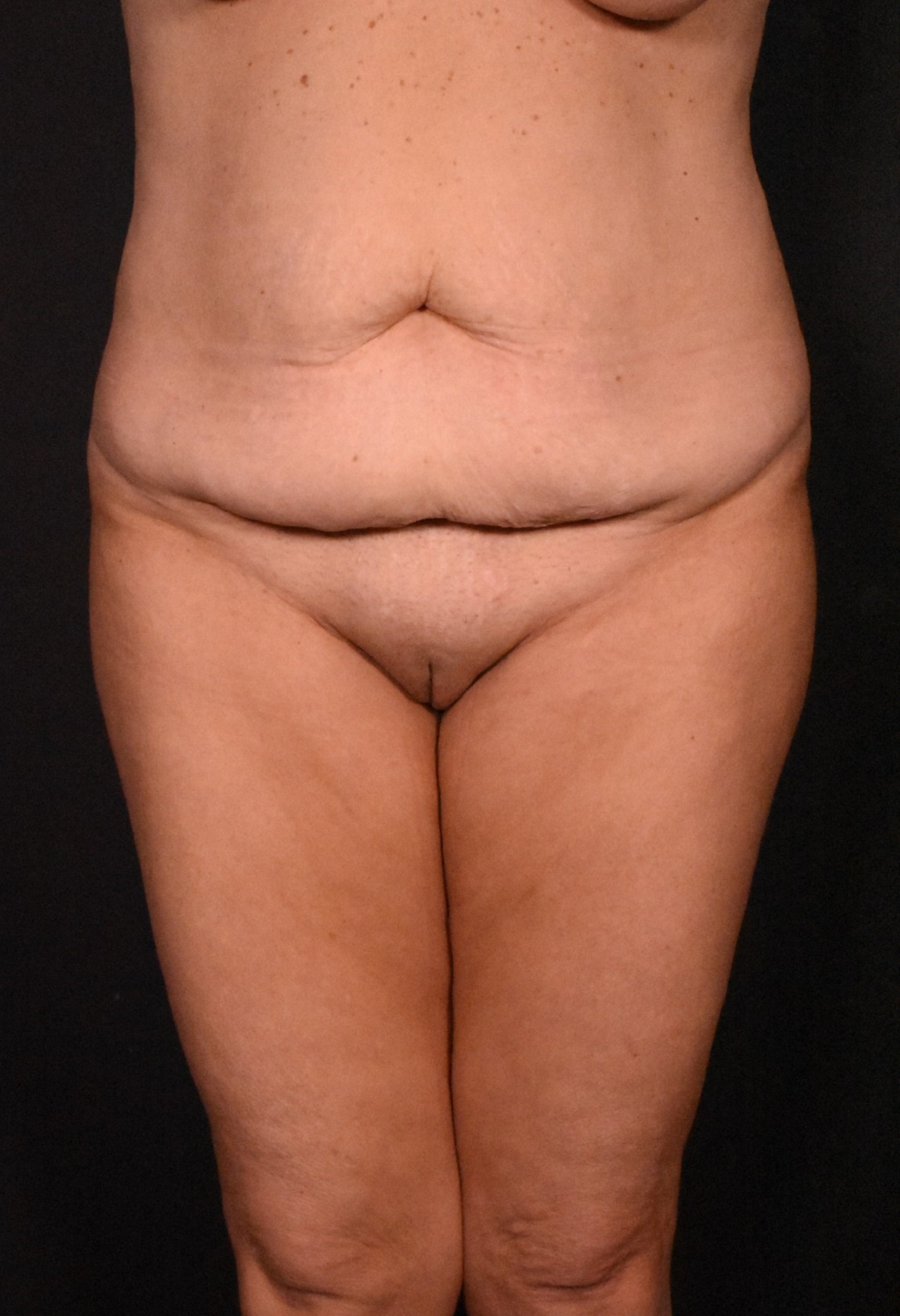 before tummy tuck front view female patient case 6727