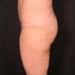 after tummy tuck side view female patient case 6727