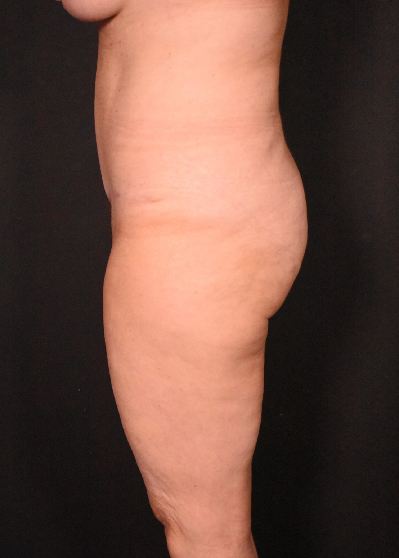 after tummy tuck side view female patient case 6727