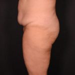 before tummy tuck side view female patient case 6727