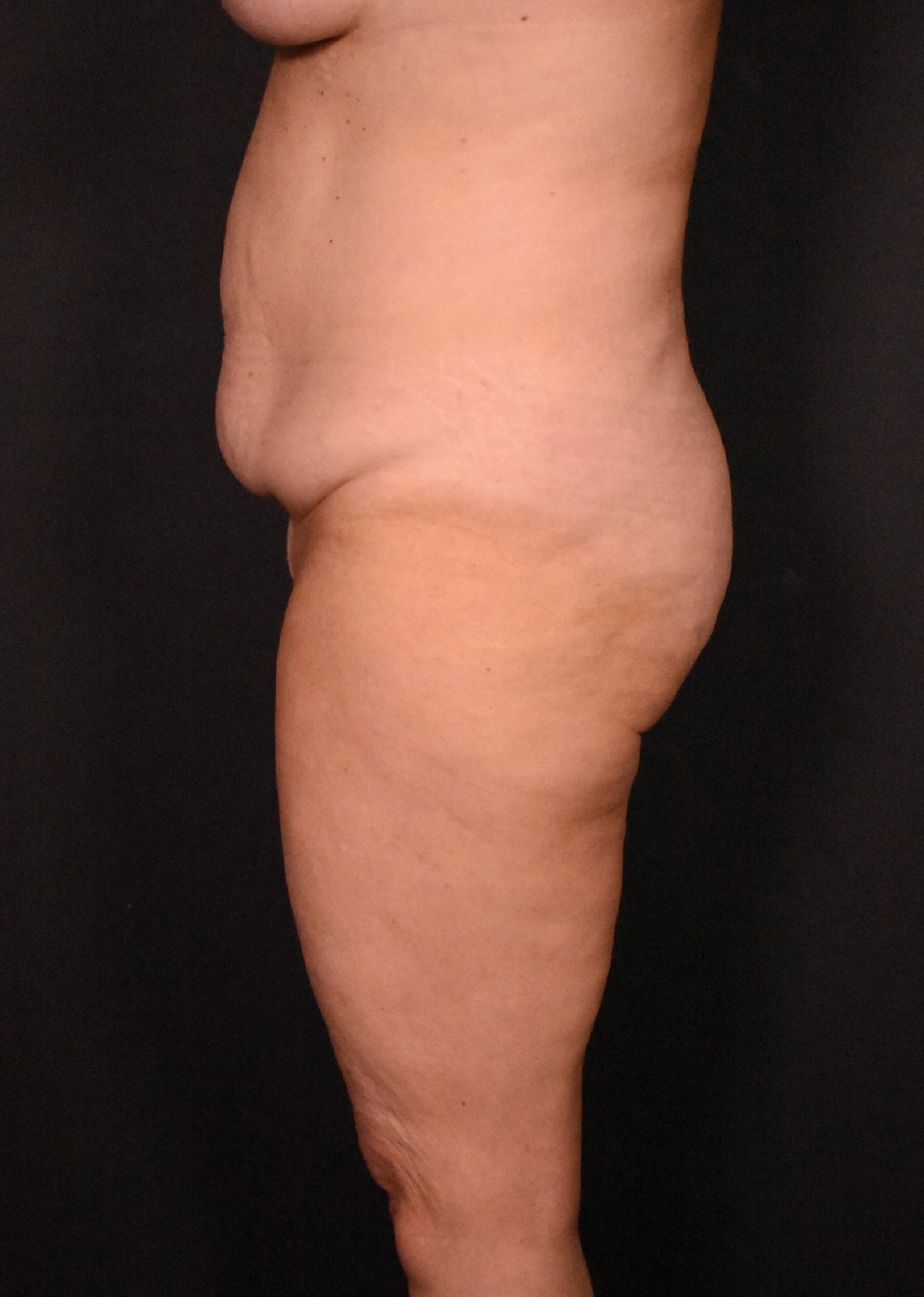 before tummy tuck side view female patient case 6727