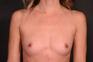 before breast augmentation front view case 6716