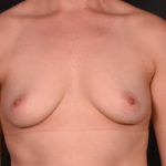 before breast augmentation front view case 6748