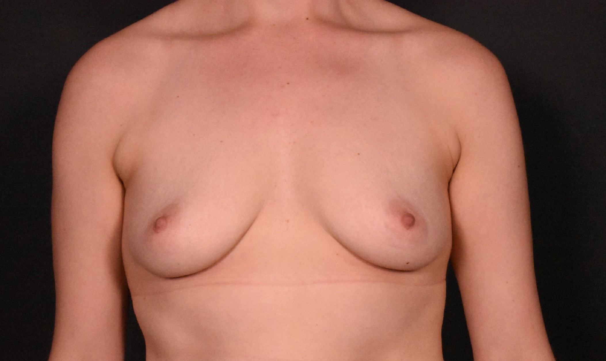 before breast augmentation front view case 6748