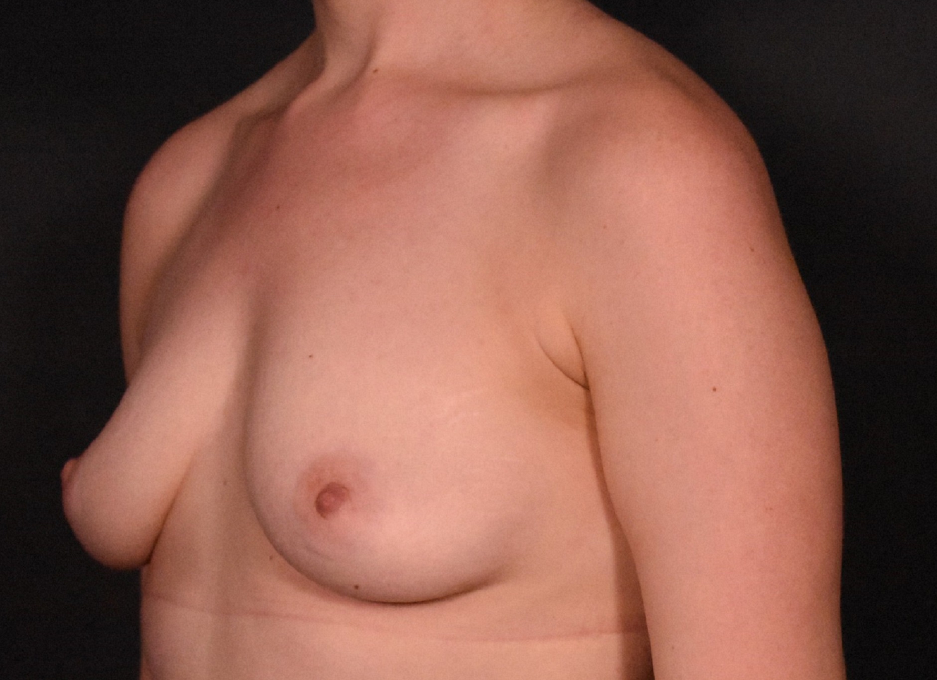 before breast augmentation angle view case 6748