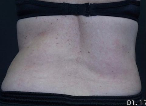 before coolsculpting female patient back view case 4379