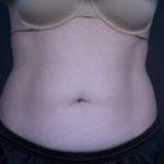 before coolsculpting female patient front view case 6772