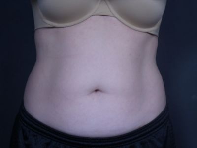 before coolsculpting female patient front view case 6772