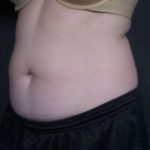 before coolsculpting female patient angle view case 6772
