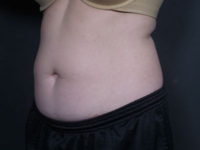 before coolsculpting female patient angle view case 6772