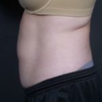 before coolsculpting female patient side view case 6772
