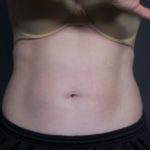 after coolsculpting female patient front view case 6772