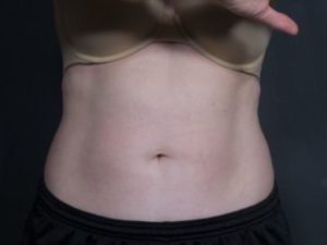 after coolsculpting female patient front view case 6772