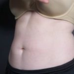 after coolsculpting female patient angle view case 6772