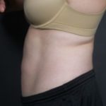 after coolsculpting female patient side view case 6772
