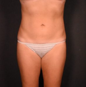 after liposuction front view female patient case 6824