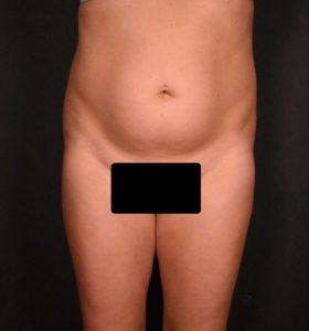 before liposuction front view female patient case 6824