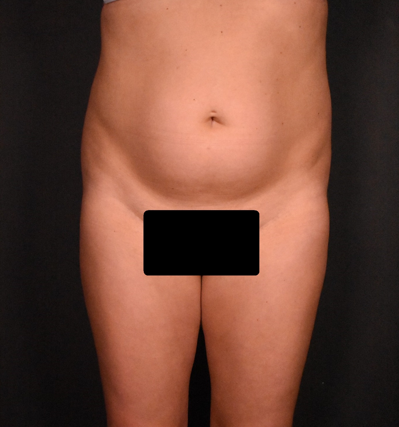 before liposuction front view female patient case 6824