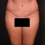 after tummy tuck front view female patient case 6977