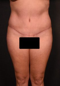 after tummy tuck front view female patient case 6977