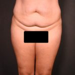 before tummy tuck front view female patient case 6977