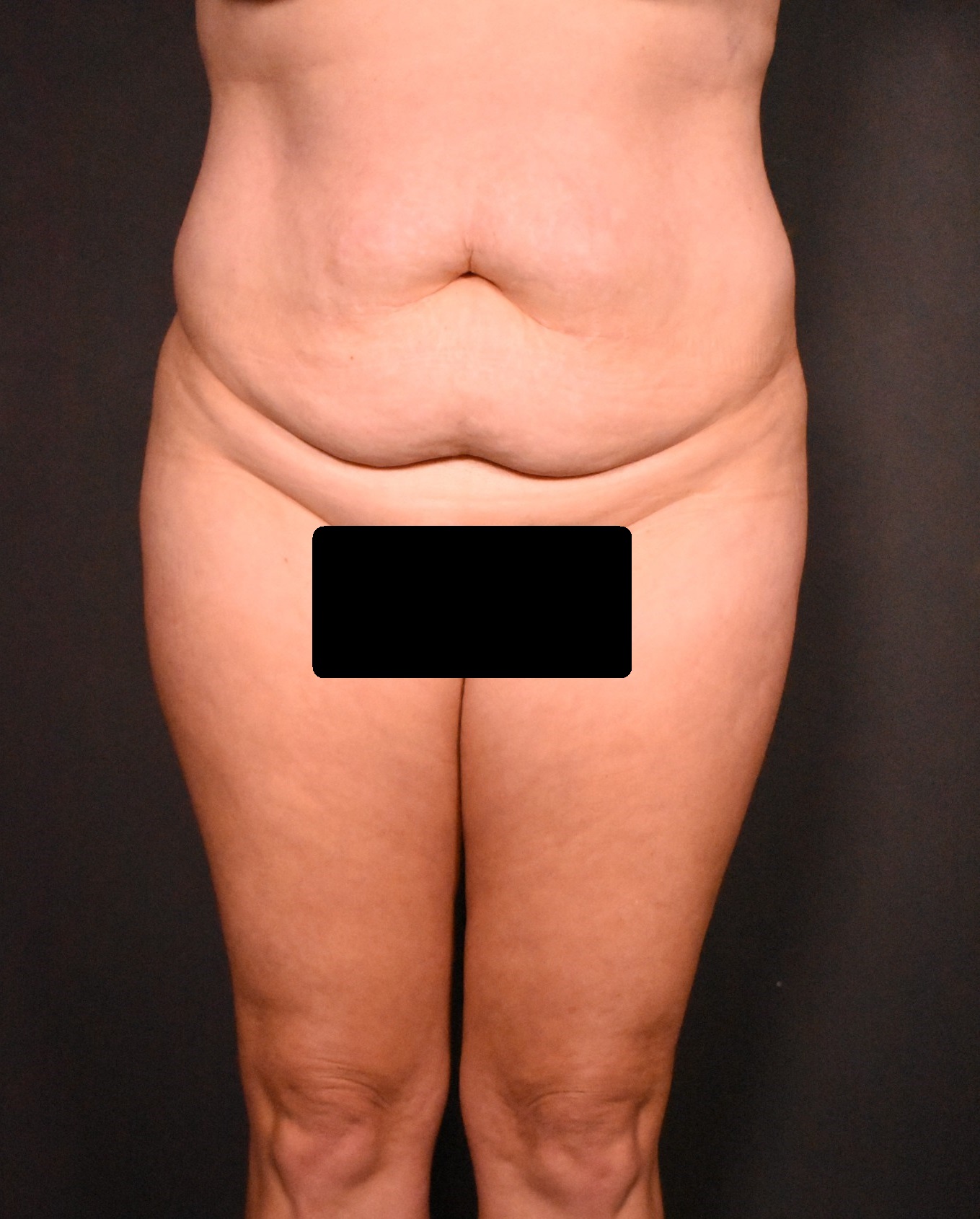 before tummy tuck front view female patient case 6977