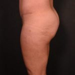 after tummy tuck side view female patient case 6977