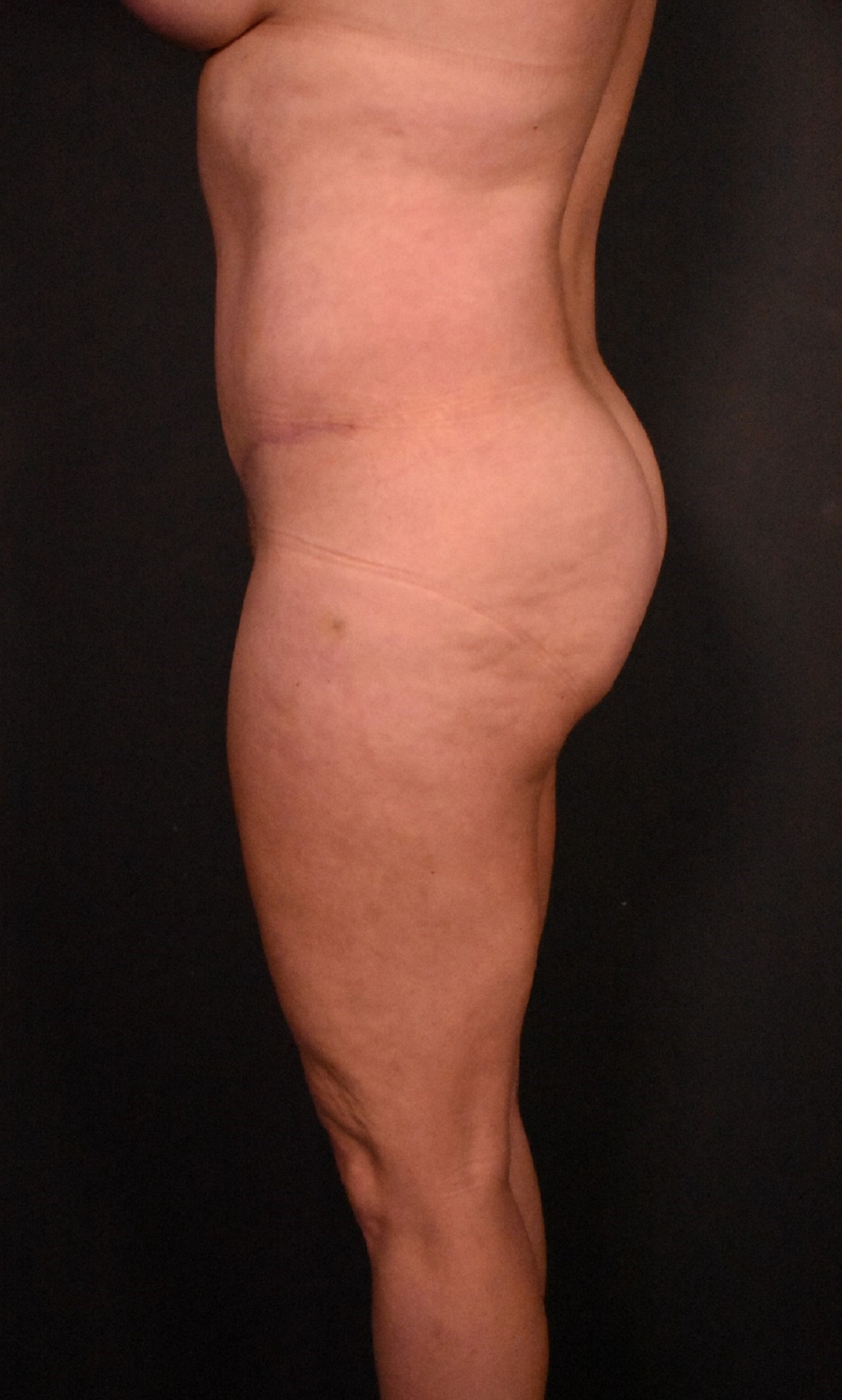 after tummy tuck side view female patient case 6977