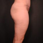 after liposuction with tummy tuck side view case 7099