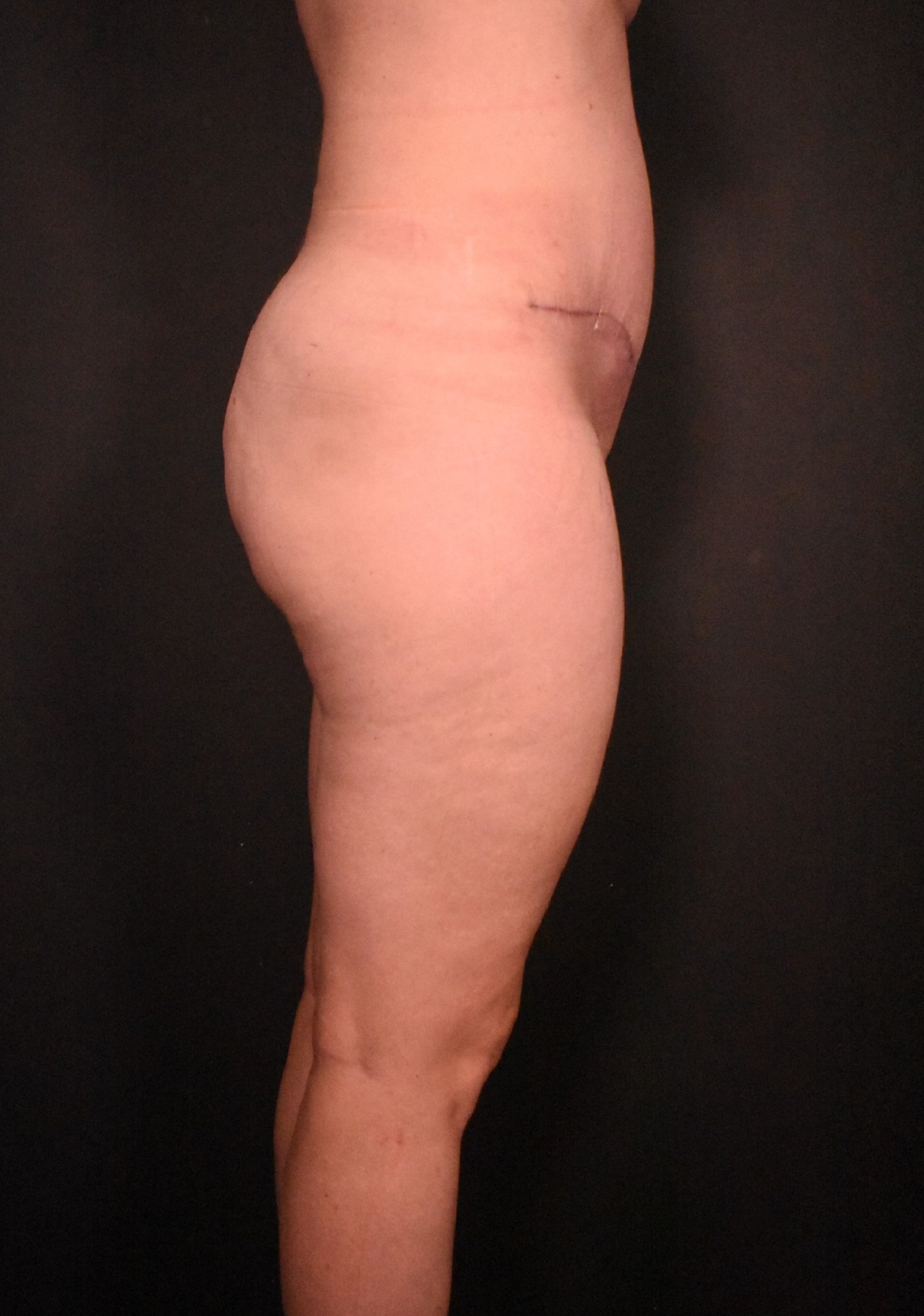 after liposuction with tummy tuck side view case 7099