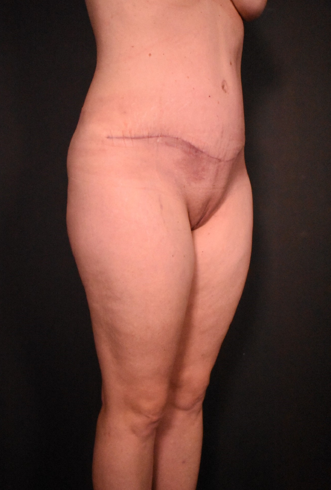 after liposuction with tummy tuck angle view case 7099