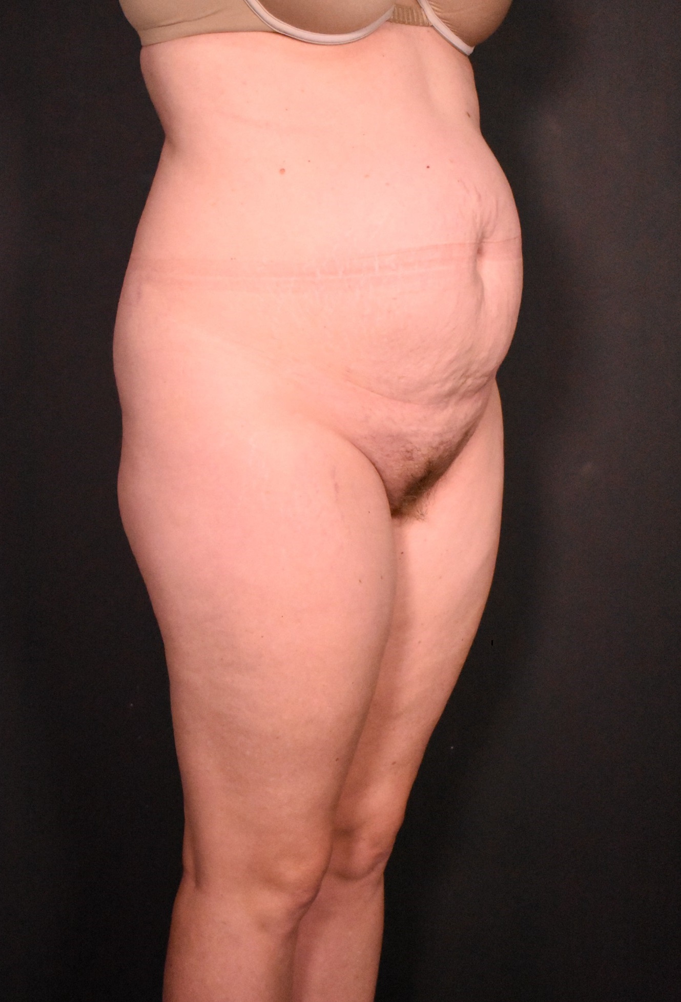 before liposuction with tummy tuck angle view case 7099