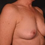 after breast lift angle view case 7094