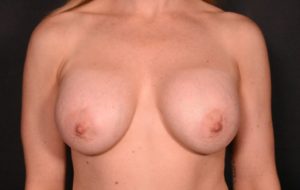 before breast lift with implant removal front view case 7116