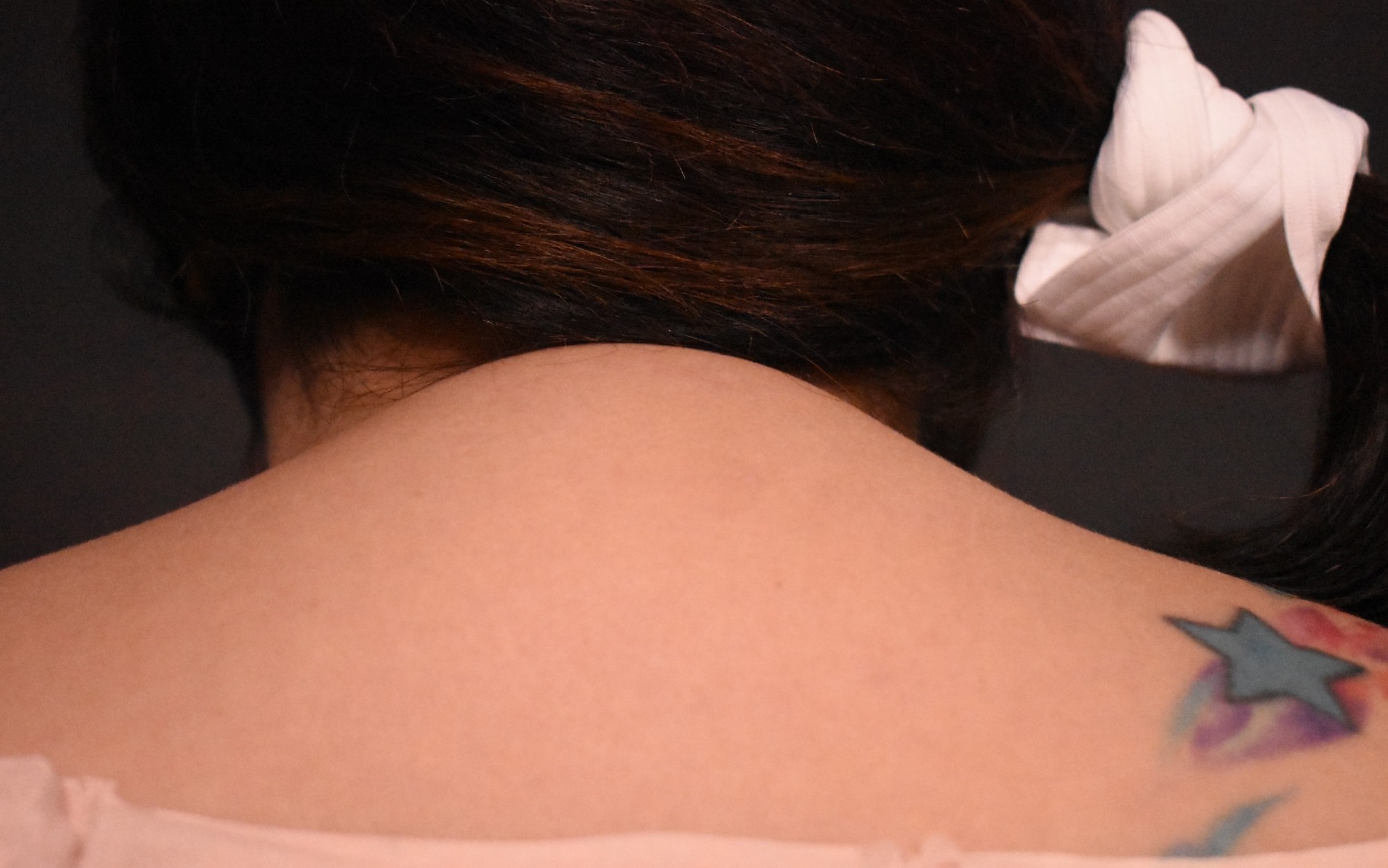 before liposuction back view female patient case 7113